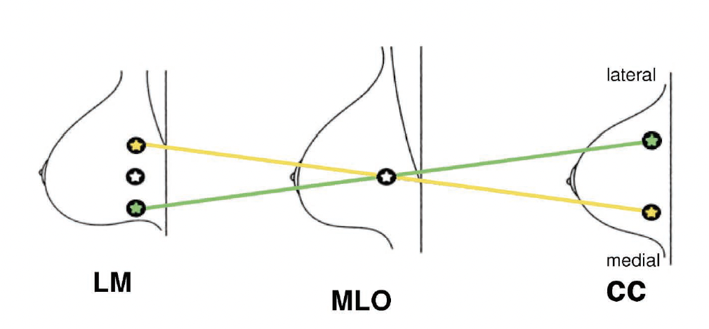 breast triangulation